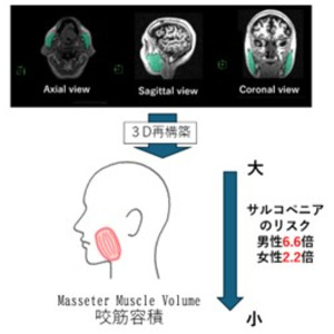 咬筋容積の低下がサルコペニアリスクを高める