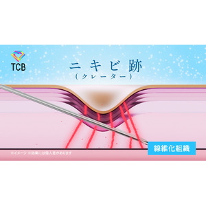 TCB東京中央美容外科の新テレビCM「デコボコしたニキビ跡改善」篇　3月1日(土）より全国でオンエア開始