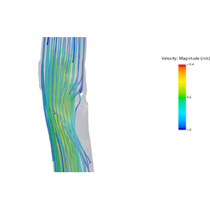 【学会発表】弘前大学との共同研究「SPシャント手術の血流制御法におけるCFD(数値流体力学)研究」（2024年度日本胸部外科学会）