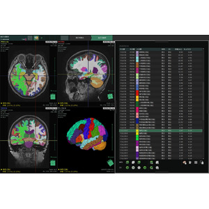 AI（人工知能）を用いた脳容積解析ソフトウェアを開発
