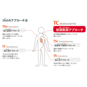 経カテーテル大動脈弁治療（TAVI）用のバルーン拡張型人工心臓弁 本邦における治療オプションがさらに拡大